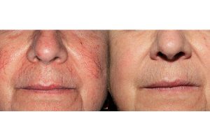 Laser thread vein removal - Aesthetox Glasgow